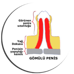 gomulu-penis